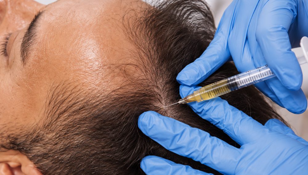 PRP and GFC hair treatment at Pigment Skin Clinic