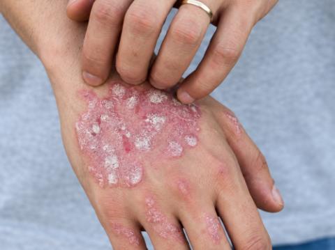 Psoriasis treatment