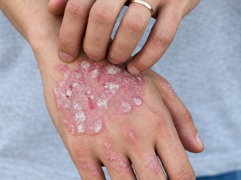Psoriasis treatment at Pigment Skin Clinic