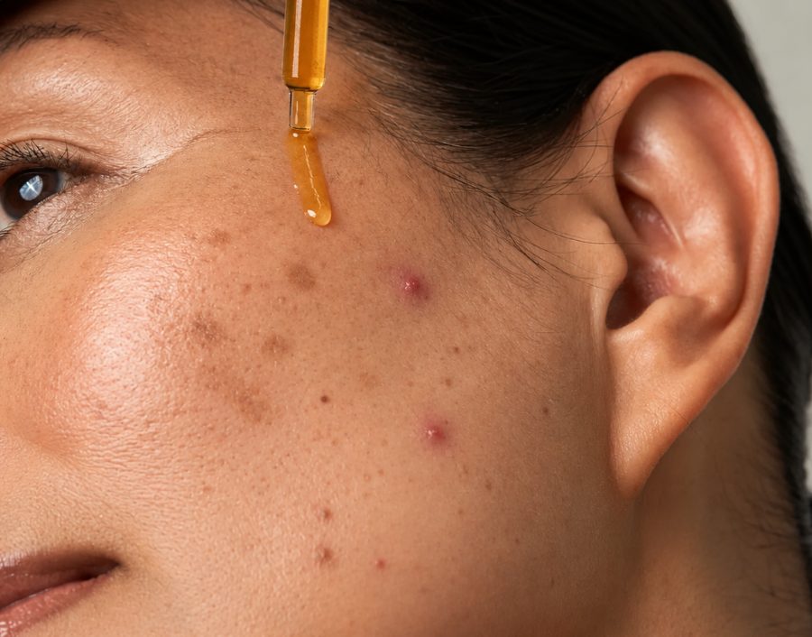 Acne treatment at Pigment Skin Clinic